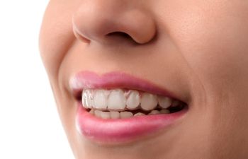 Close-up of a person smiling with clear dental braces on upper teeth.