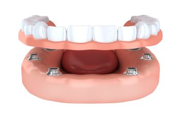 Image of a set of upper dentures placed above lower gums with dental implants.