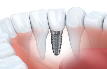 Illustration of a dental implant in a row of teeth, showing the metal screw embedded in the gum and topped with a white crown.